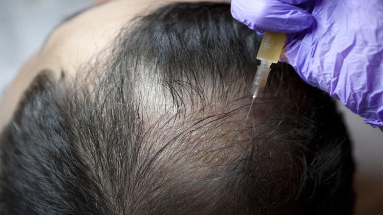 Benefits of Prp Injections for Hair Loss Treatment
