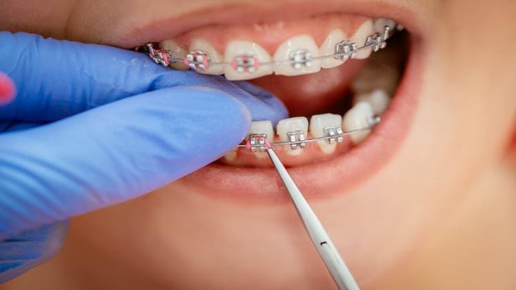How Can We Straighten Our Teeth?