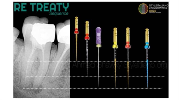 All the Factors Related To Quality Endodontic Rotary Files - Trendingbird